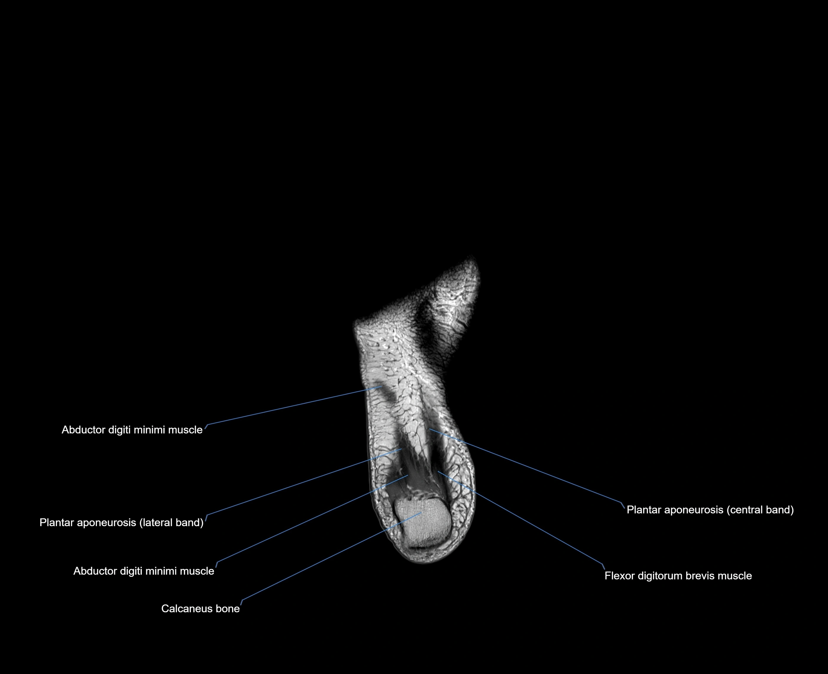 MRI foot coronal cross sectional anatomy 3T  radiology  image-img-00001-00031.webp